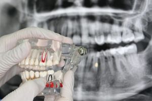 implantes dentales en herrera