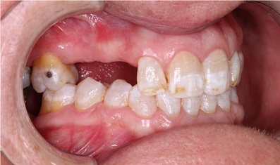 Prótesis fija sobre diente - Antes