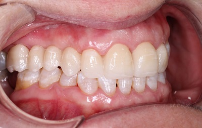 Prótesis fija sobre diente - Después