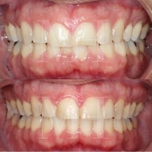 Antes y después de tratamiento de ortodoncia en Herrera, Sevilla