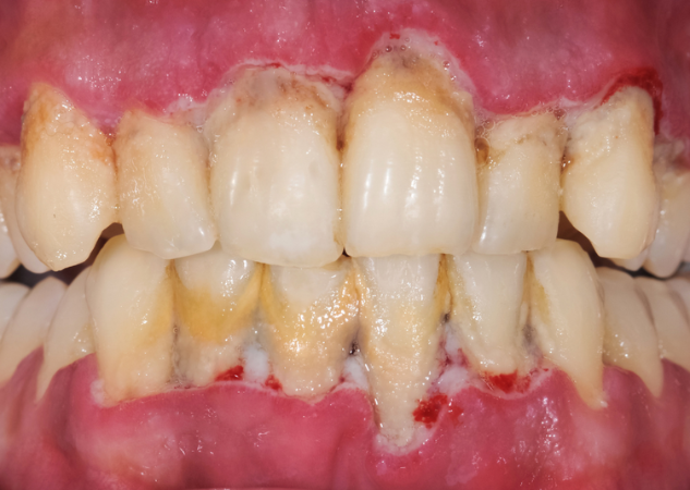 Caso de periodontitis