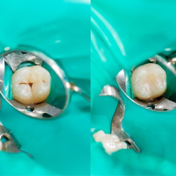 Empaste dental en Herrera