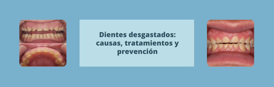 Dientes desgastados: causas, tratamientos y prevención